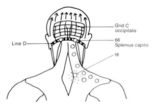 Head and Neck Trigger Points